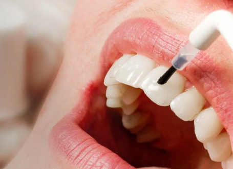 Topicación con flúor